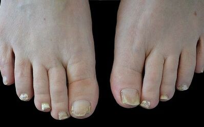 Nola kendu onddoak hatzetan