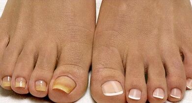 Flota onddoen tratamendu metodoak