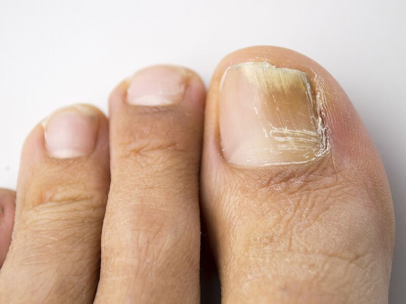 Onddoaren hasierako etapa